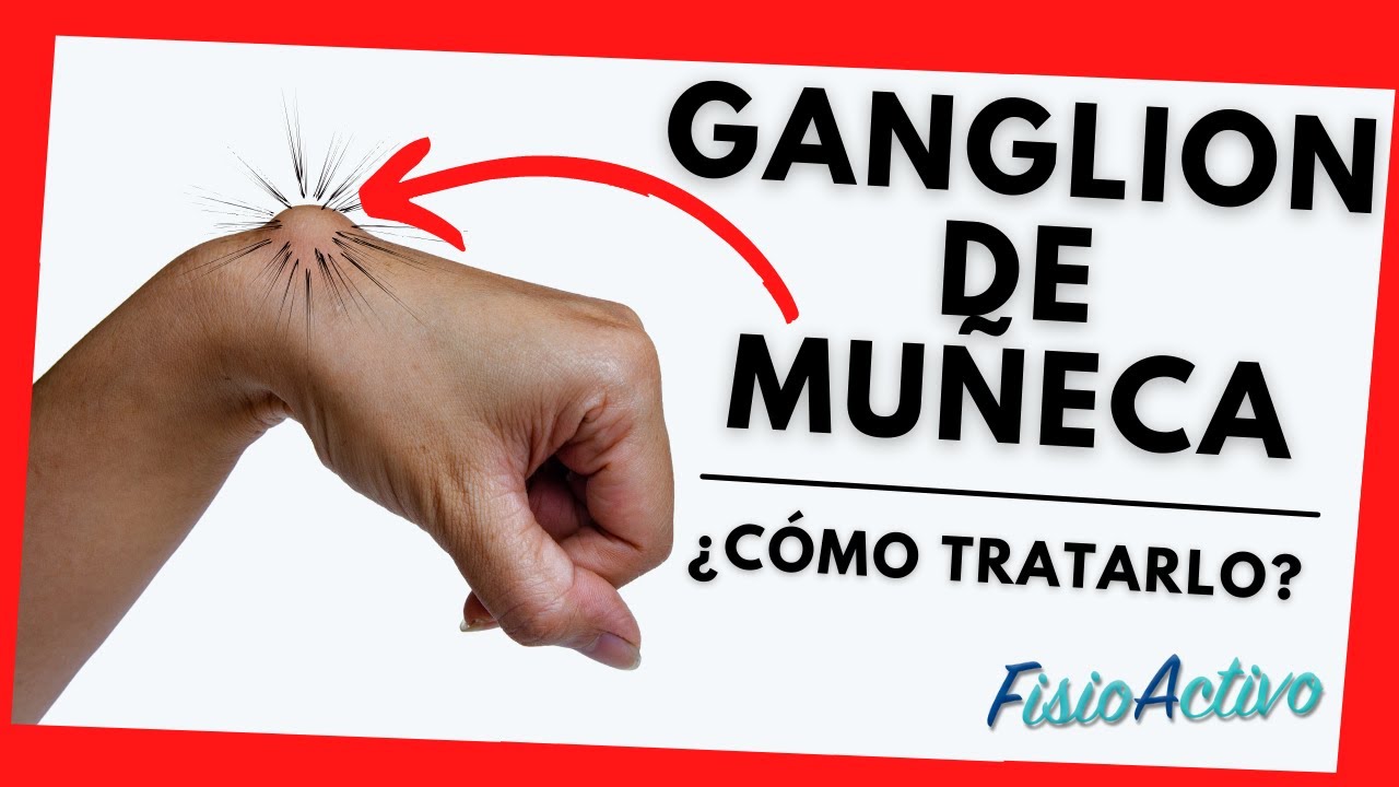 baja laboral por ganglión en muñeca