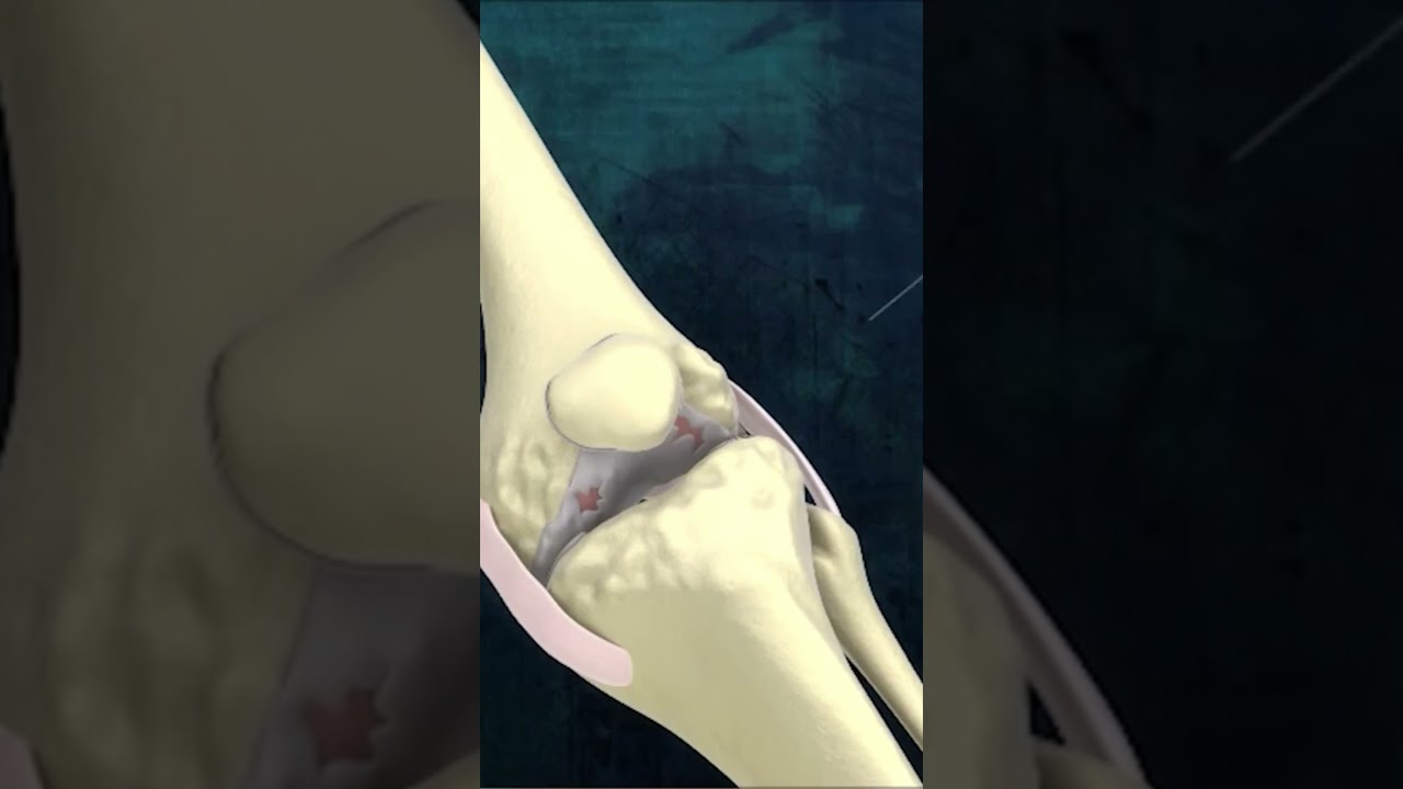 infiltraciones celulas madre en rodilla seguridad social