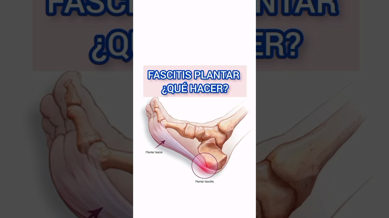 grado de discapacidad por fascitis plantar