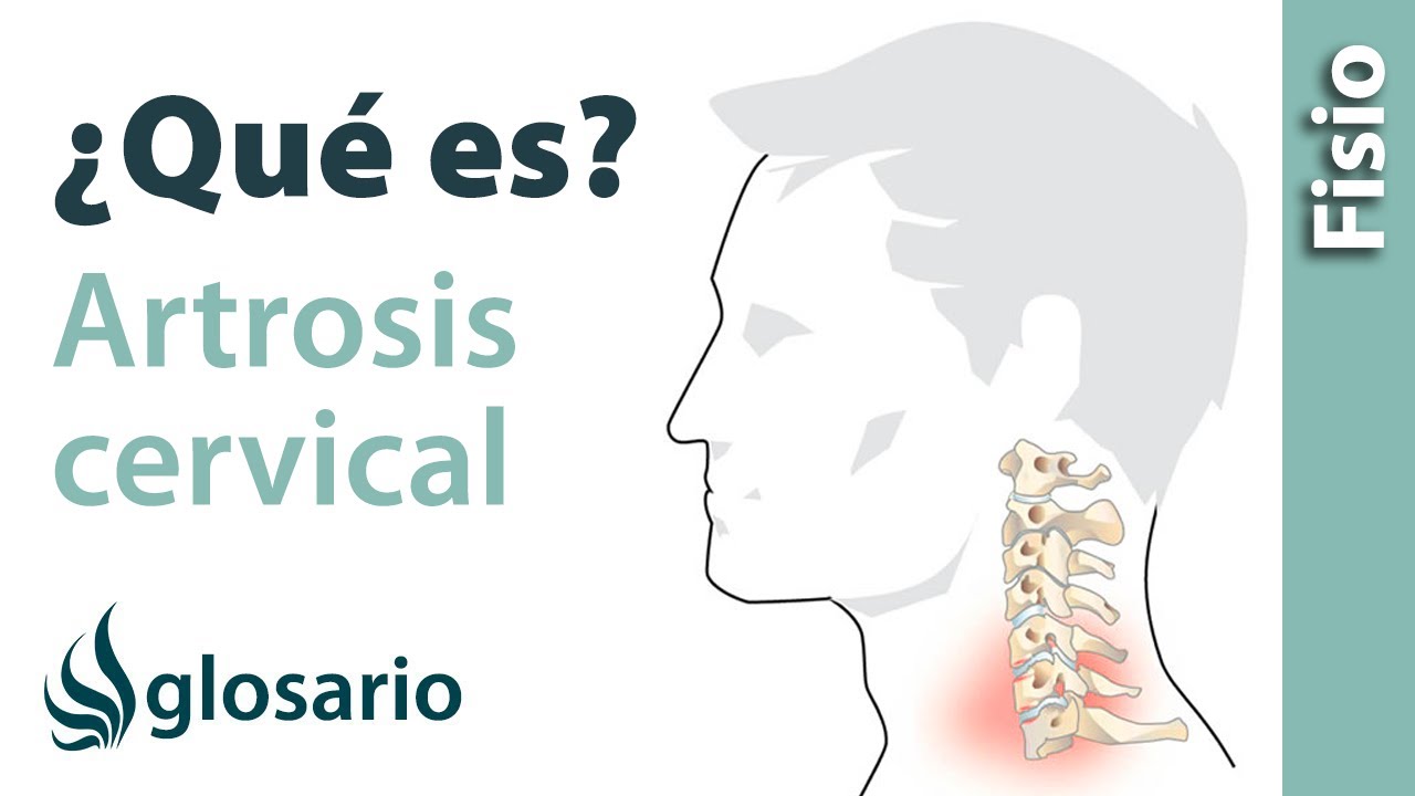 te pueden dar una paga por artrosis cervical