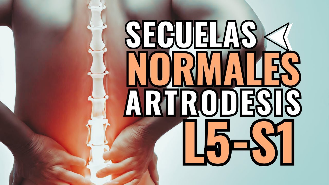 incapacidad permanente artrodesis lumbar l4 l5 s1 secuelas